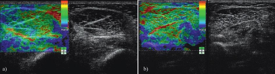 a) Left thigh and b) right thigh before injection (gray scale US and sonoelastography).