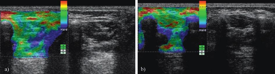 a) Right pronator teres muscle before injection (gray scale US and sonoelastography) predominantly