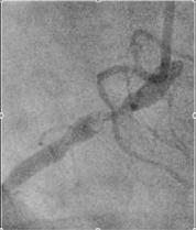 Case 3 - Angiography Patent LAD stent,