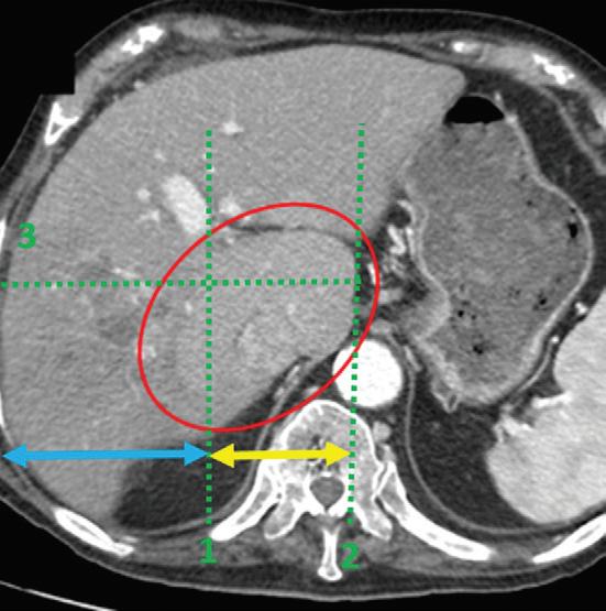 Cross-sectional Imaging CT: Caudate lobe hypertrophy MRI: