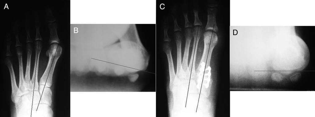 P. Dayton et al. / The Journal of Foot & Ankle Surgery xxx (2015) 1 10 3 Fig. 2. (A) The transverse plane deviation of the metatarsal observed on an anteroposterior radiograph.