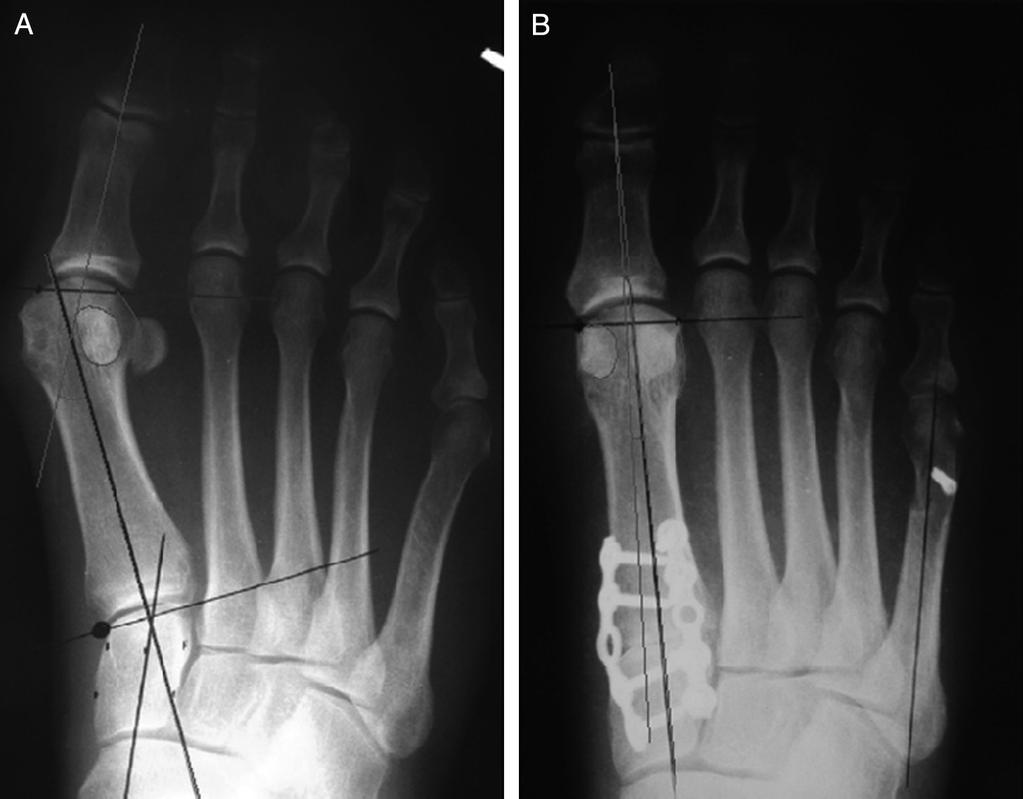 4 P. Dayton et al. / The Journal of Foot & Ankle Surgery xxx (2015) 1 10 Fig. 4. Various terms have been used to describe the frontal plane position of the first metatarsal in a bunion deformity.