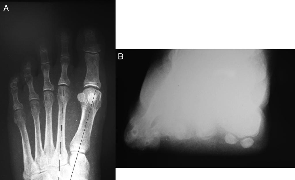 P. Dayton et al. / The Journal of Foot & Ankle Surgery xxx (2015) 1 10 5 Fig. 6. (A) Weightbearing anteroposterior radiograph showing a tibial sesamoid position of 5.