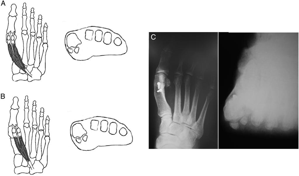 The sesamoid position on the anteroposterior radiograph is not indicative of the true sesamoid position owing to the altered perception that the valgus (pronated) metatarsal rotation imparts.