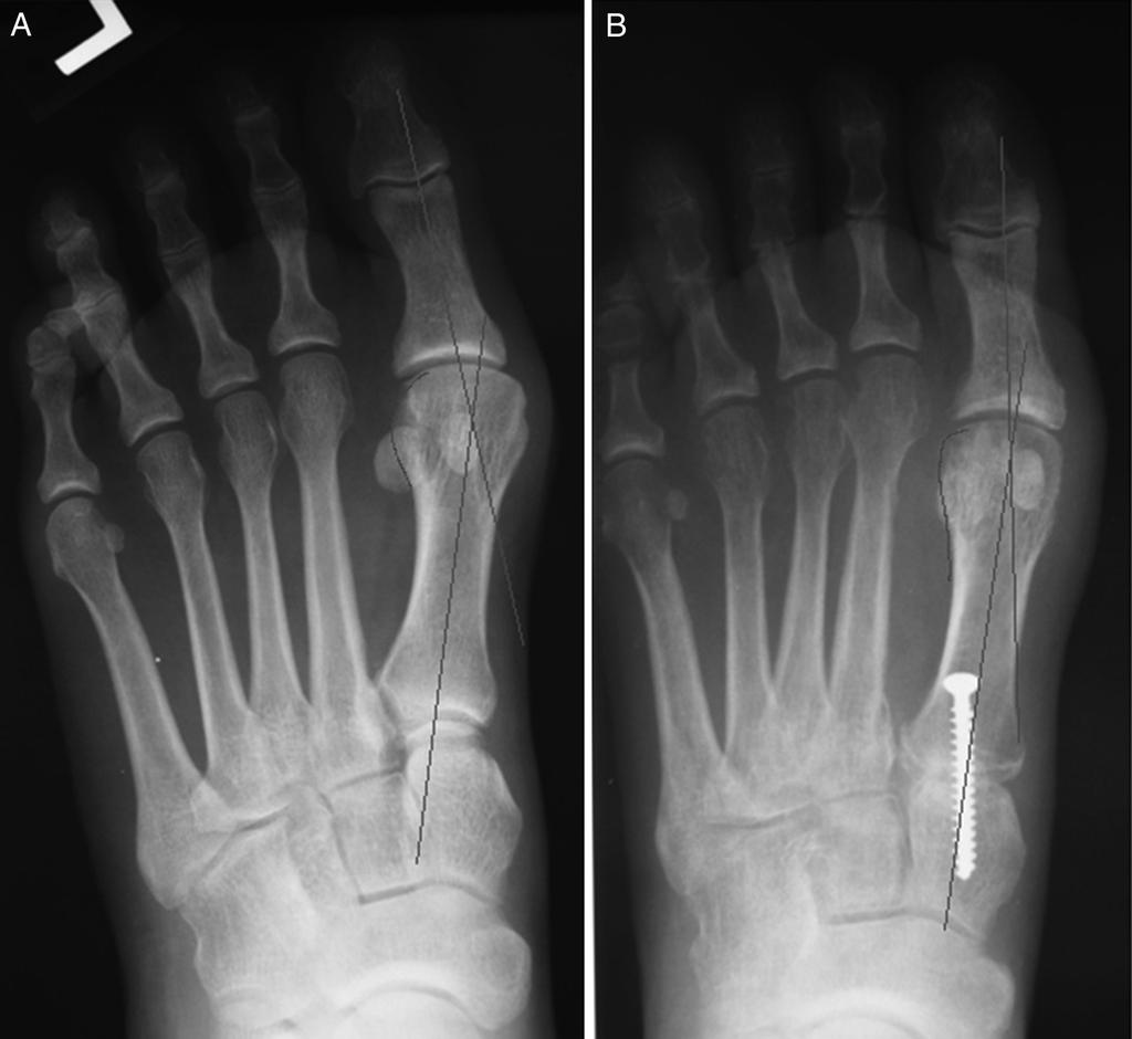 P. Dayton et al. / The Journal of Foot & Ankle Surgery xxx (2015) 1 10 7 Fig. 9. (A and B) A Lapidus procedure was performed by 1 of us (P.D.) in which the valgus or pronated position of the metatarsal was addressed.