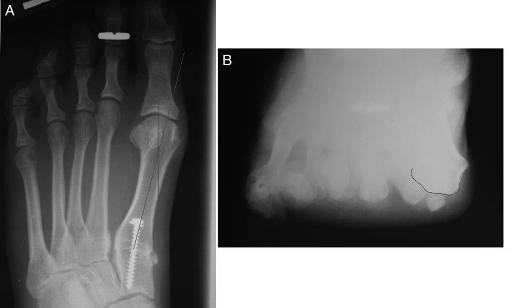 The metatarsophalangeal joint is still everted or pronated and not in anatomic alignment despite the intermetatarsal angle correction.
