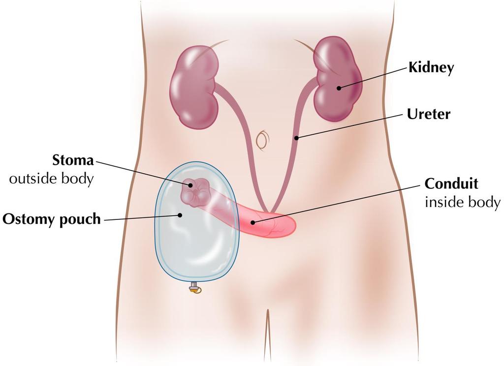 Surgery to create a new way for urine to leave the body Ileal Conduit: The surgeon takes a short segment of the small intestine and connects one end to the stoma.