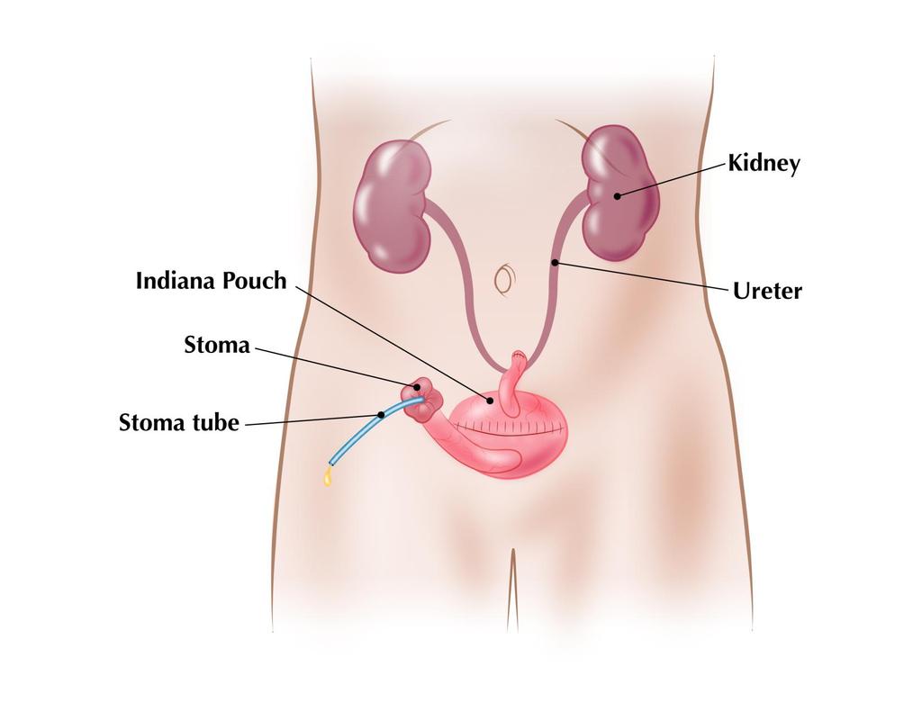 Indiana Pouch: An Indiana Pouch is a pouch made from part of your bowel to store urine. The surgeon will create a pouch which is brought out through an opening made on your abdomen.