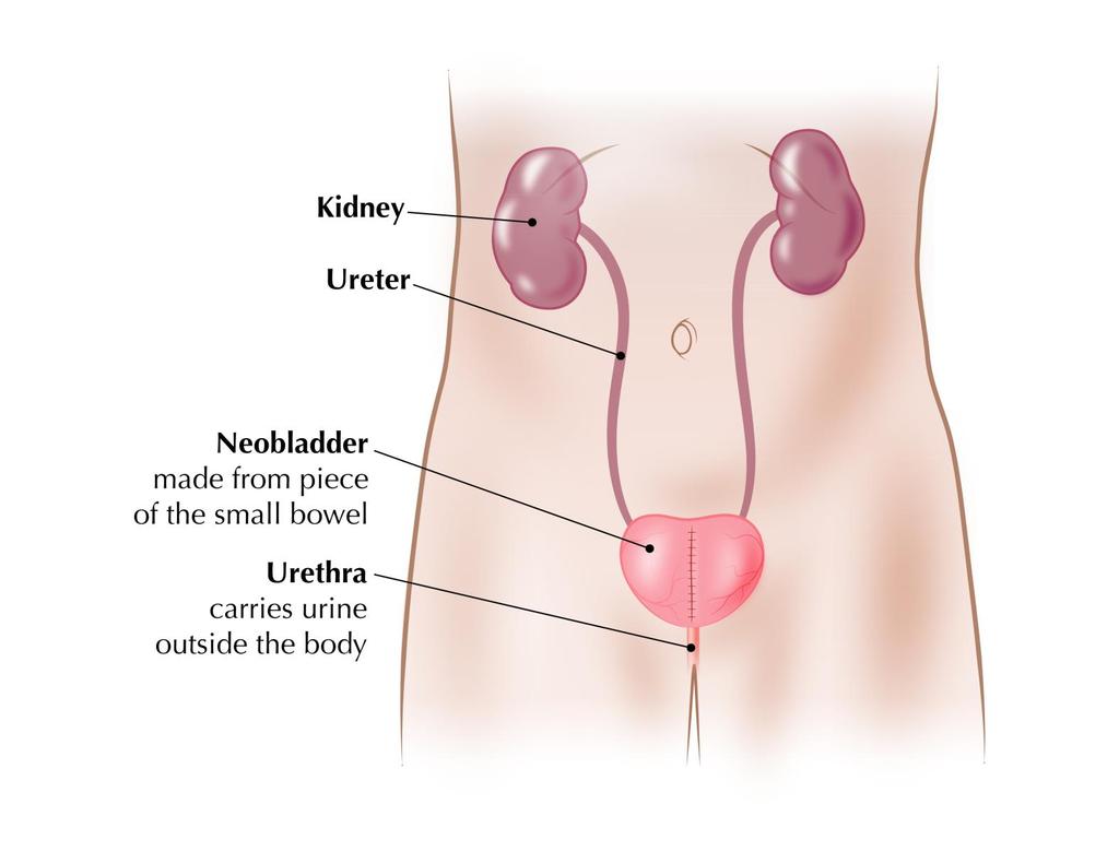 Neobladder: A neobladder replaces the bladder by using part of the large bowel.