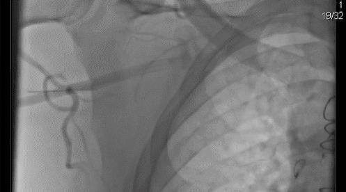 Reasoning for Access Point Landmark Circumflex humeral Thoracoacromial 1.