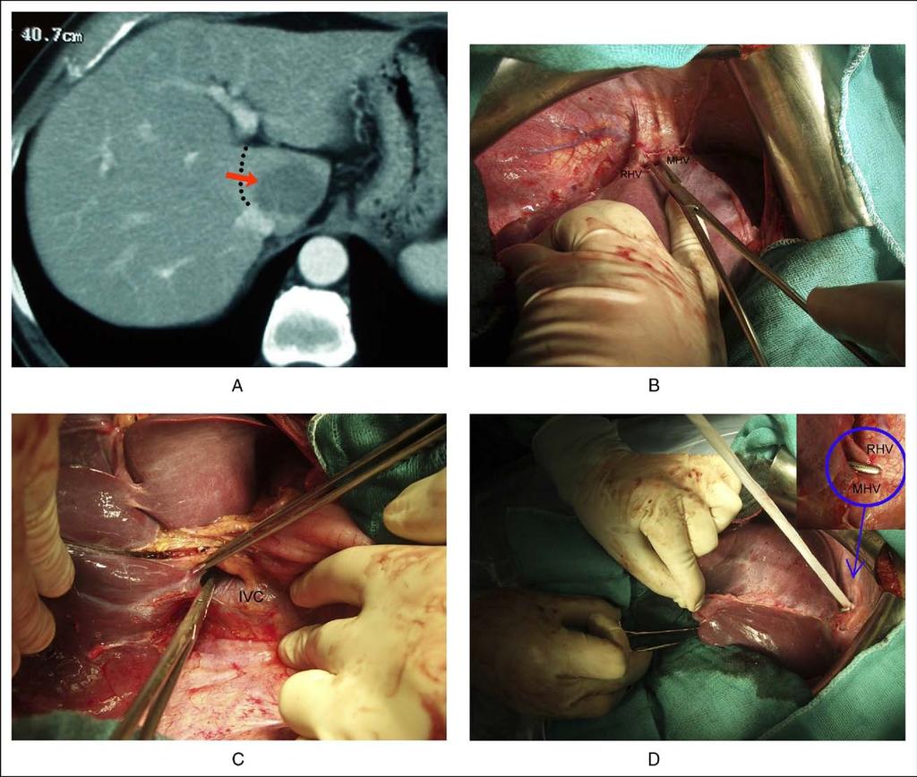 R. Lopez-Andujar et al. Resection of segment 1 of the liver e43 Figure 1 (A) Transversal computed tomography scan image with a metastasis in segment 1 (red arrow).
