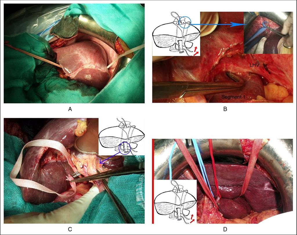 R. Lopez-Andujar et al. Resection of segment 1 of the liver e45 Figure 2 (A) The tape is placed on the anterior surface of the retrohepatic IVC.