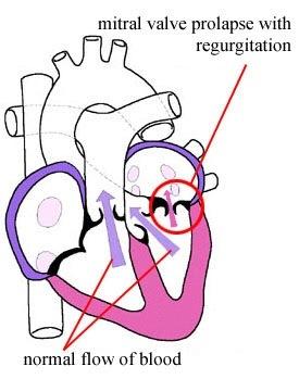 Mitral Valve Prolapse Most common cardiac variation (5-10% of population) Mitral valve cusps do not close properly