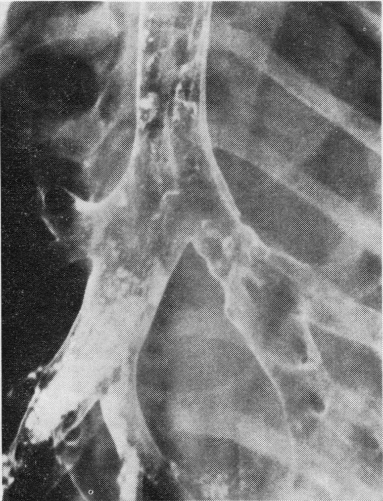 Tantalum appeared to pool in the bronchus immediately distal to the anastomosis but eventually the tantalum was completely cleared across the anastomosis (Fig. 6). FIG. 5. Tantalum bronchogram.