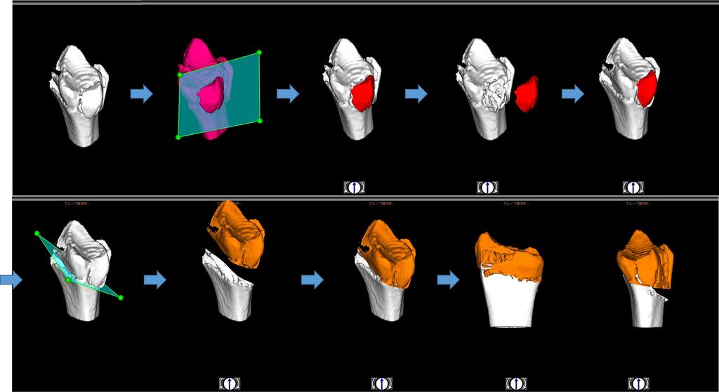 3D PLANNING FOR THE DISTAL RADIUS FRACTURE 2647 medicine (DICOM) data from CT scans.