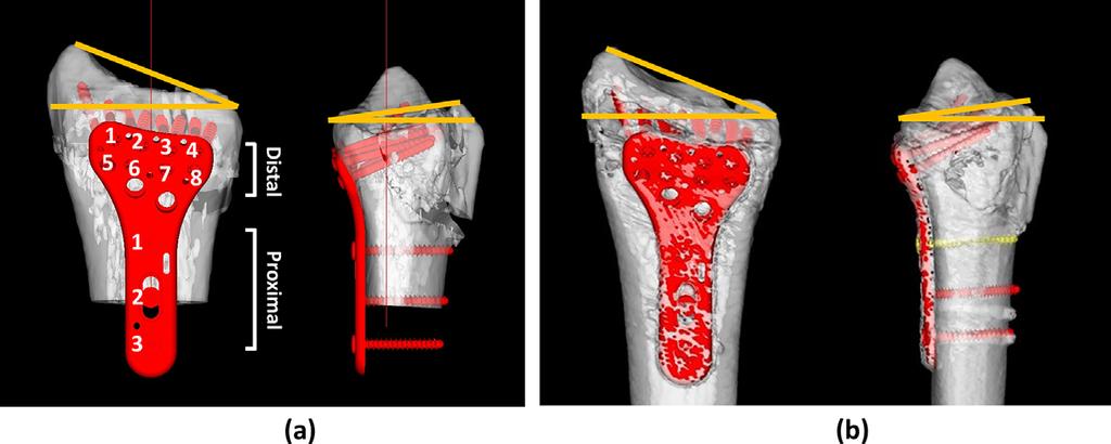 This was checked with axial, coronal, and sagittal views of the repositioned bone outline. considered moderate, between 0.60 and 0.74 was considered good, and between 0.75 and 1.