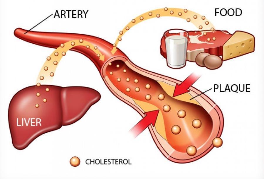 Cholesterol Cholesterol is a waxy fat carried through the bloodstream by lipoproteins HDL High density lipoproteins Good cholesterol LDL Low density Lipoprotein Bad