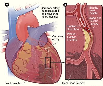 Cardiovascular disease refers to