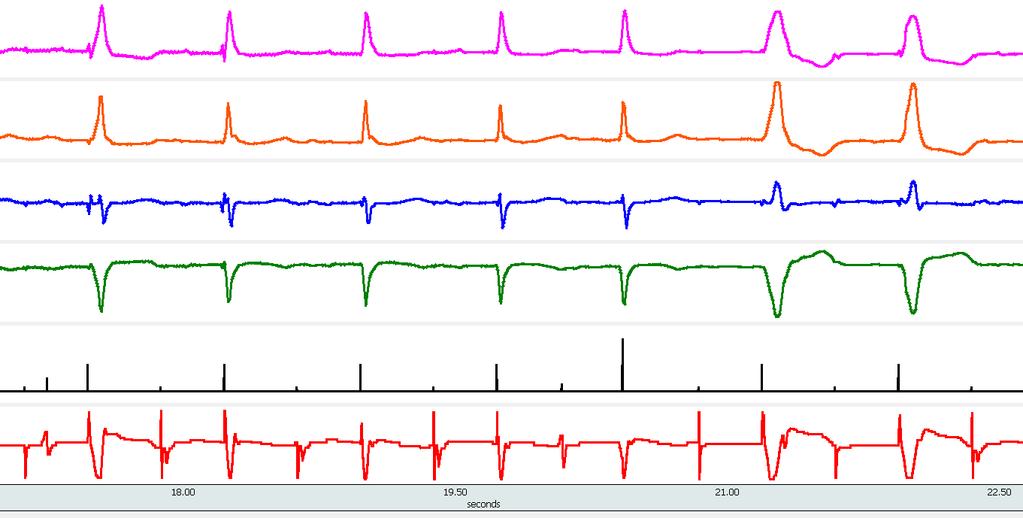 and atrium: I II III avr markers Ap As Vp As Vs iecg Fusion Pseudofusion in DDD