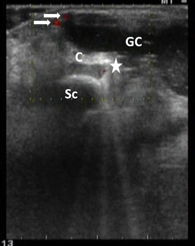 e34 M. YAMAMOTO ET AL. FIGURE 3. Color Doppler sonography shows the branches of the radial artery (arrows).