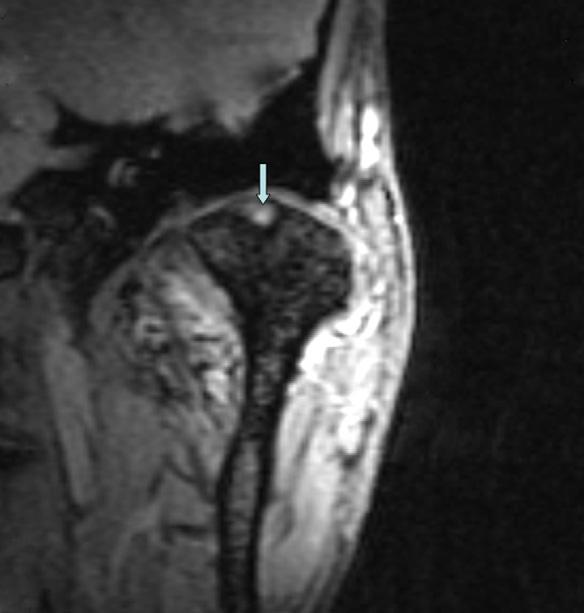 136 Y.H. Yu et al. / British Journal of Oral and Maxillofacial Surgery 51 (2013) 133 137 Fig. 4. T2 weighted coronal image showing strong signals (arrows) on the joint surface of the condylar process.
