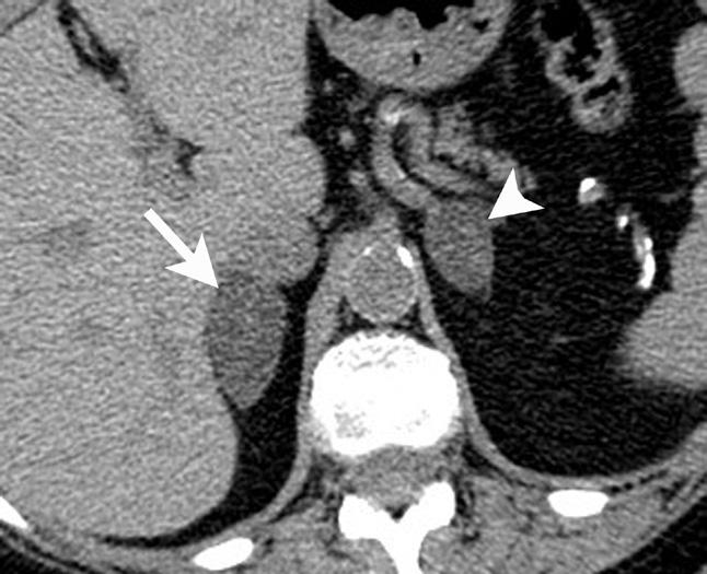 8 Adrenal cysts are rare but can be easily diagnosed on CT or MRI. On CT, the typical adrenal cyst has a Hounsfield attenuation close to that of water (< 20 HU) and it does not enhance.