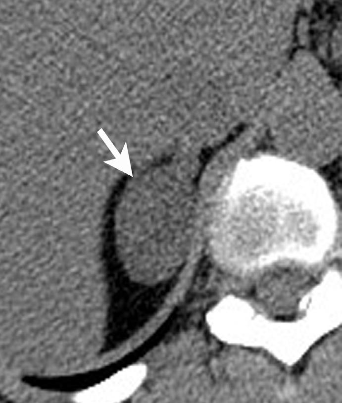 A B C FIGURE 5. Lipid poor adenoma of the right adrenal gland. (A) Right adrenal mass (arrow) measures 16 HU on nonenhanced CT.