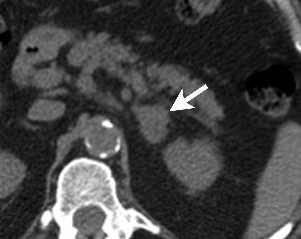 C D FIGURE 6. Adrenal malignancy. (A) 62-year-old male with lung cancer. Left adrenal mass (arrow) measures 35 HU on nonenhanced CT.