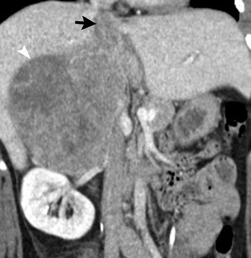 (D) Axial fused (F18)FDG-PET/CT image demonstrates high FDG avidity of right adrenal mass (arrowhead) seen in C.