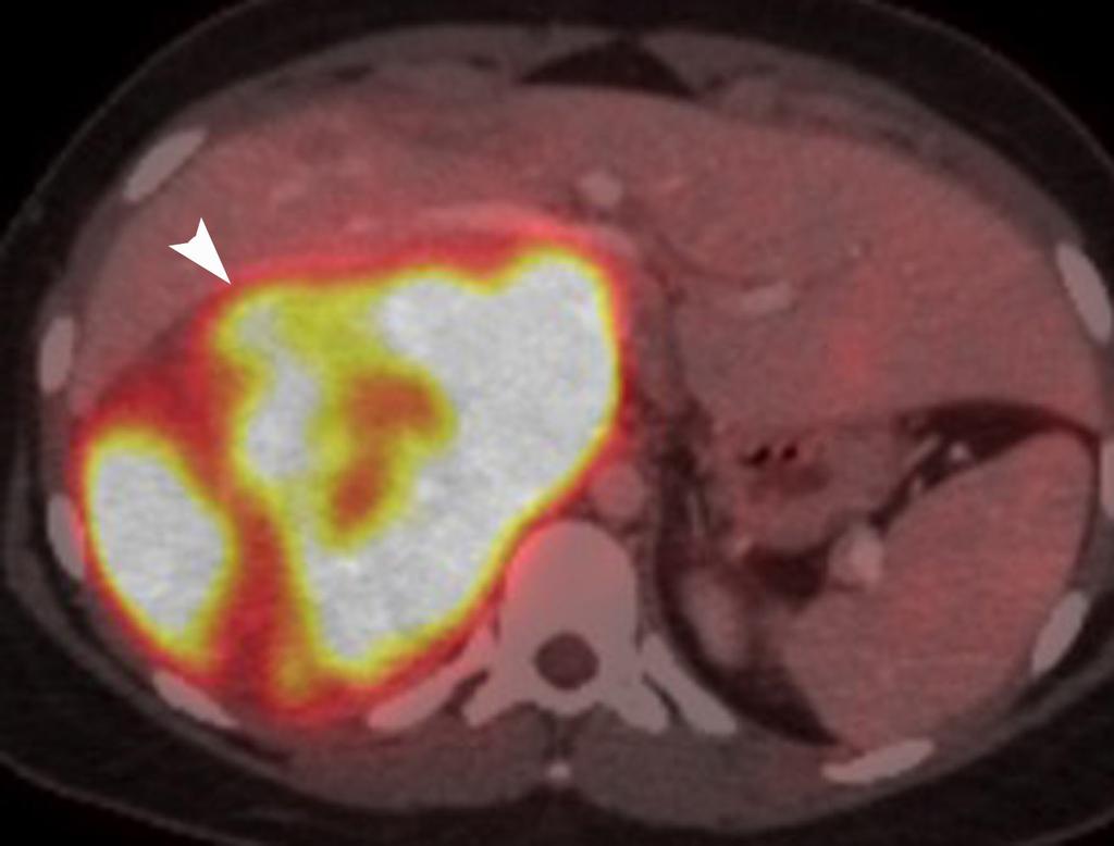 Adrenal cortical carcinoma is typically very large at presentation and has propensity to invade the inferior vena cava.
