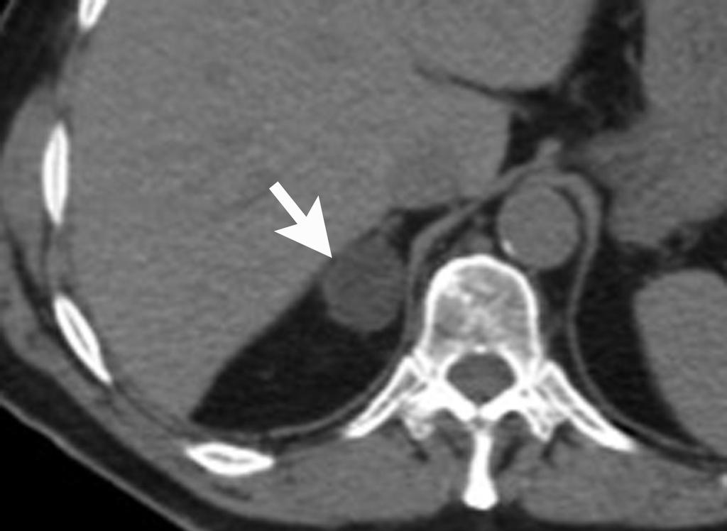 A B FIGURE 7. Lipid-rich adrenal adenoma of the right adrenal gland. (A) Right adrenal mass (arrow) with attenuation value of + 2HU on nonenhanced CT, consistent with a lipid-rich adenoma.