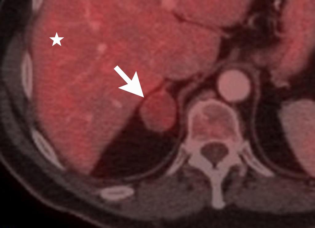 Left adrenal mass biopsy. Solid left adrenal mass (arrow) with indeterminate imaging characteristics on non-enhanced CT, CT with washout, and MRI (not shown).