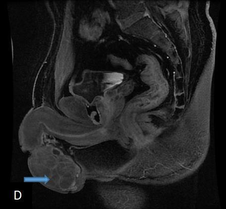 (B) Coronal T2-weighted and sagittal T2-weighted MRI