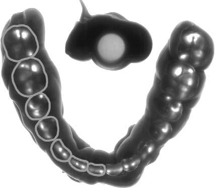 MORPHOLOGICAL OCCLUSION IN POSTORTHODONTIC PATIENTS 27 Figure 1. Scnned imge of the occlusl registrtion (mndibulr surfce fcing downwrd) in one orthodontic ptient.