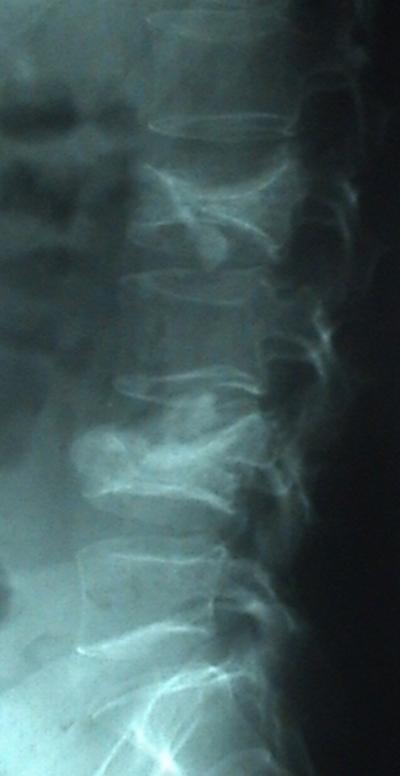 Figure 8 Figure 9 Figure 3b Figure 3c DISCUSSION The term vertebroplasty refers to percutaneous (through the skin) structural reinforcement of the vertebral body using a special cement-like substance
