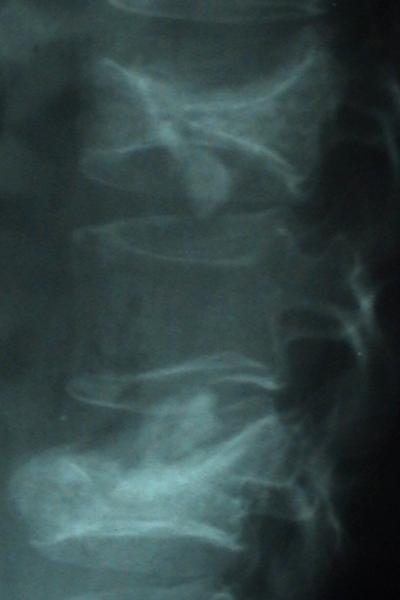 Over the past 21 years the indications have been expanded to include tumors of the spine that spread (e.g. cancer) and osteoporotic vertebral collapse.