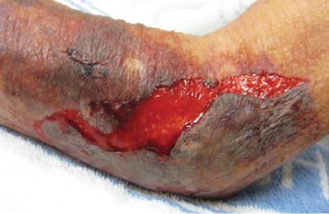 What is a chronic wound A wound that does not heal along an expected course Skin Tears can quickly become