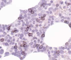 Hematopathology / ORIGINAL ARTICLE A B C Image 2 Bone marrow clot section from a child with increased numbers of B cells, including florid hematogone proliferation.