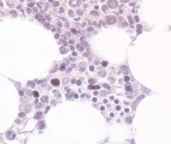Again, the cells are less frequent than CD20+ cells seen in Image 2A (TdT, 400).