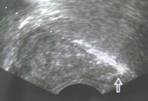 56 Prostate Biopsy transverse image, the direction of the biopsy device should be as in the figure
