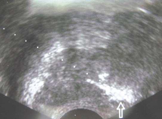 Tip of needle should face on the side of rectum. (a) (b) Fig. 2.