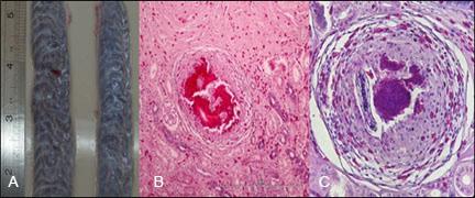 Figure 7: Kidneys. Grossly, the kidneys were pale and surrounded by thick web-like adhesions (A).
