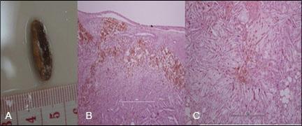 intralesional chronic heterophilic granuloma (B) and parasitic granuloma formation (C). Figure 4: Liver.