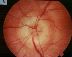 CN II: Optic Nerve Pathology Papilledema.