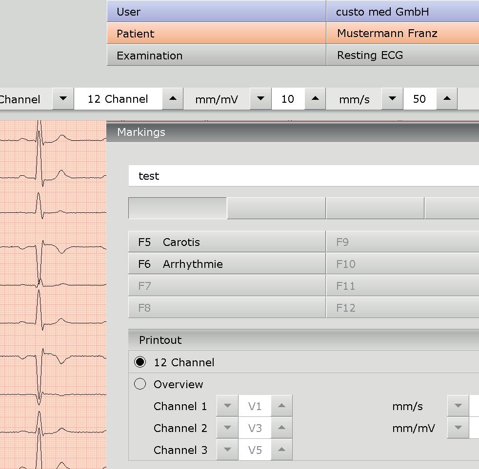 Editing options during the recording process Automatic marking of the ECG Clicking on the Marker button will automatically mark the last six seconds of the recording.