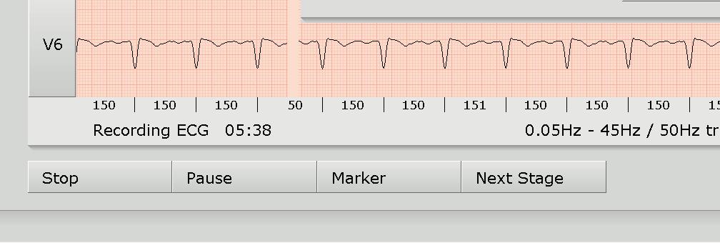 The recovery phase proceeds according to the profile. If you would like to end the ECG recording but the ECG signal should still be displayed on the screen, click on Stop.