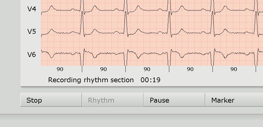 In the evaluation, the available rhythm strips can be called and
