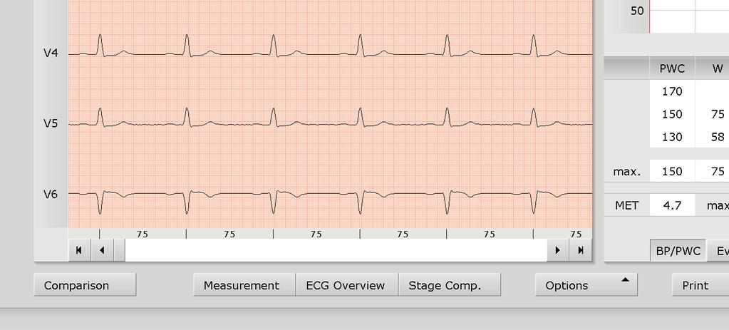 Navigation in the stress ECG evaluation The buttons for opening further evaluation screens are located at the bottom of the