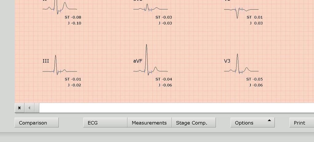 You go to the Measurement evaluation screen and the previously clicked Measurement button changes to ECG.