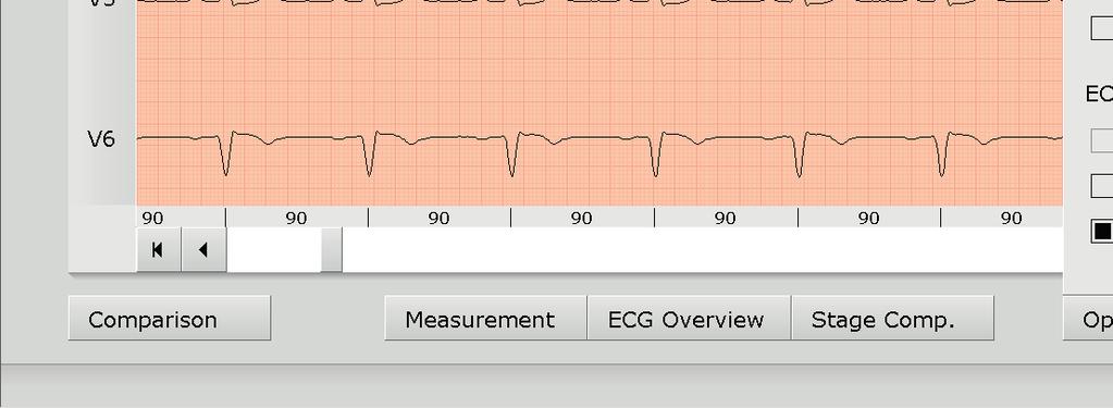 (Options: Display ECG as saved, unfiltered or filtered ECG - mains filter, muscle filter, Ergo-filter) Show or hide content in the right half of the screen: Summary complexes and report or table of